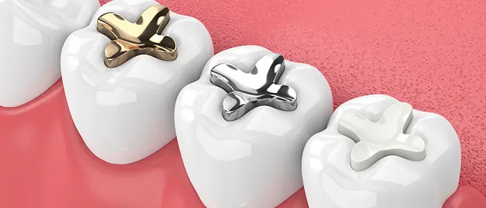 Dental Fillings Northville Mi
