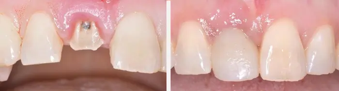 Dental Implant Insertion Northville Mi