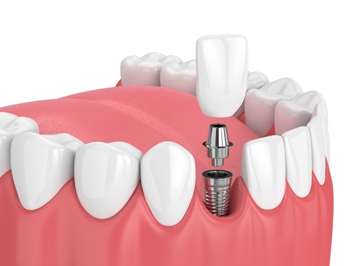 Dental Implants Northville Mi