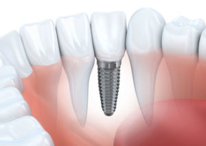 Northville Mi Dental Implants