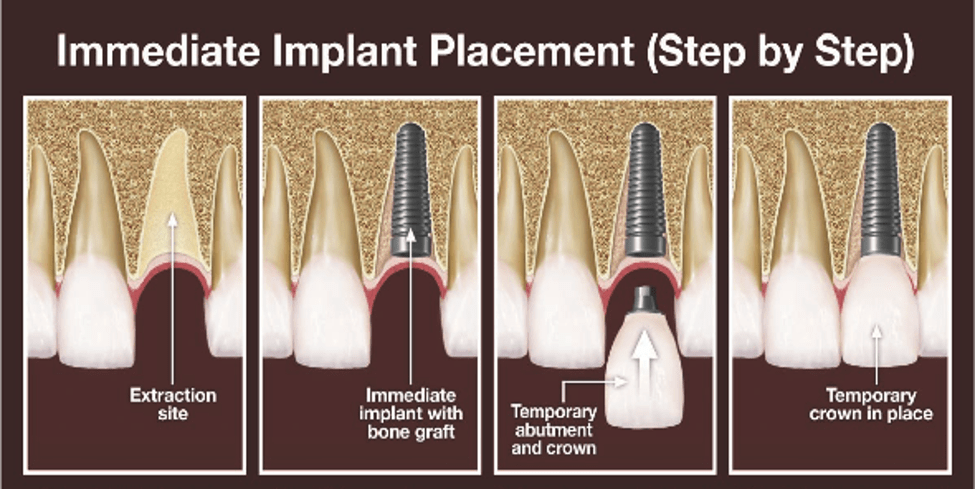 Dental Implant Procedure Northville Mi