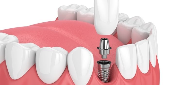 Dental Implants Northville Mi